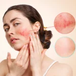 health tips of skin disease when suddenly comes redness on face